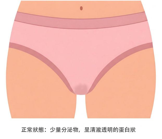 正常狀態: 每日有少量分泌物屬正常